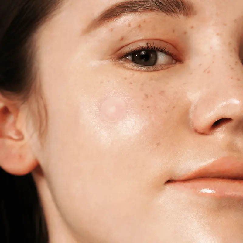 ISNTREE - Onion Newpair Spot Patch Basic – Korean skincare by TOTOKA